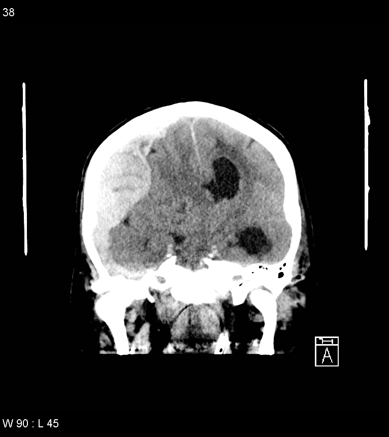 Acute subdural hematoma with myelofibrosis (Radiopaedia 52582-58494 Coronal non-contrast 29).jpg