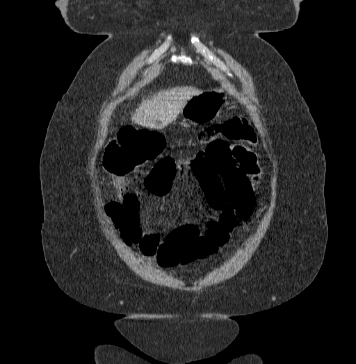 File:Acute superior mesenteric artery occlusion (Radiopaedia 51288-56960 Coronal C+ portal venous phase 13).jpg