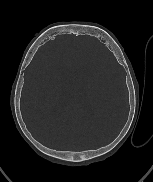 Acute traumatic subdural hematoma (Radiopaedia 82921-97257 Axial bone window 45).jpg