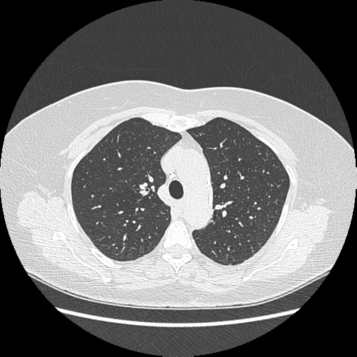 Adenocarcinoma in situ of lung (Radiopaedia 38685-40829 B 72).png