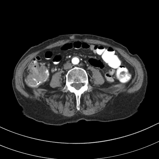Adenocarcinoma of cecum (Radiopaedia 59222-66549 Axial C+ arterial phase 89).jpg