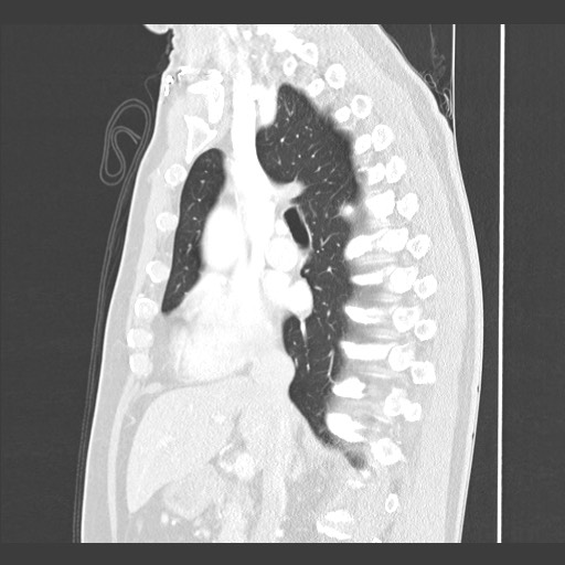 Adenocarcinoma of the lung (Radiopaedia 59871-67325 Sagittal lung window 43).jpg