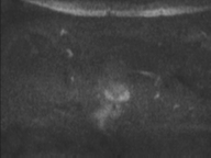 Adenocarcioma of rectum- T1 lesion (Radiopaedia 36921-38546 Axial DWI 70).png
