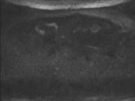 Adenocarcioma of rectum- T1 lesion (Radiopaedia 36921-38546 Axial DWI 81).png