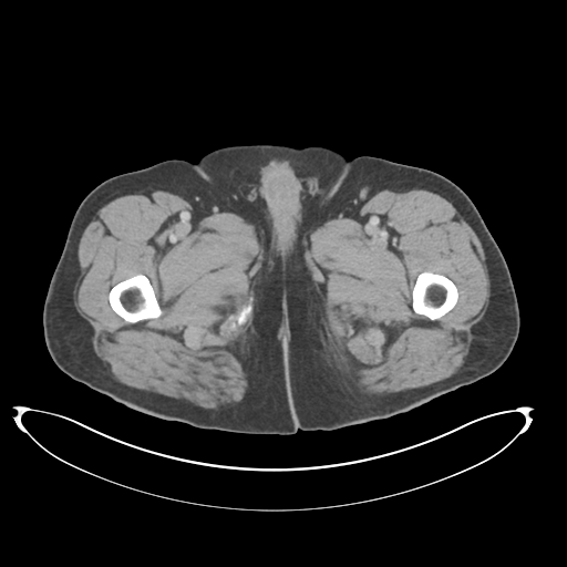 Adenocarcioma of rectum- T1 lesion (Radiopaedia 36921-38547 Axial C+ portal venous phase 100).png