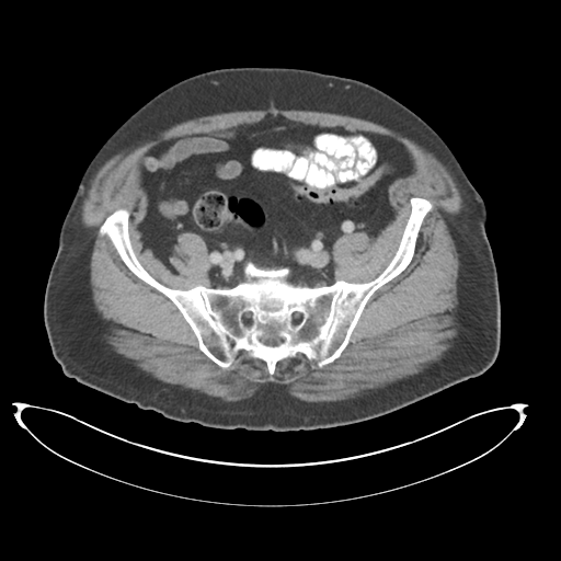 Adenocarcioma of rectum- T1 lesion (Radiopaedia 36921-38547 Axial C+ portal venous phase 68).png