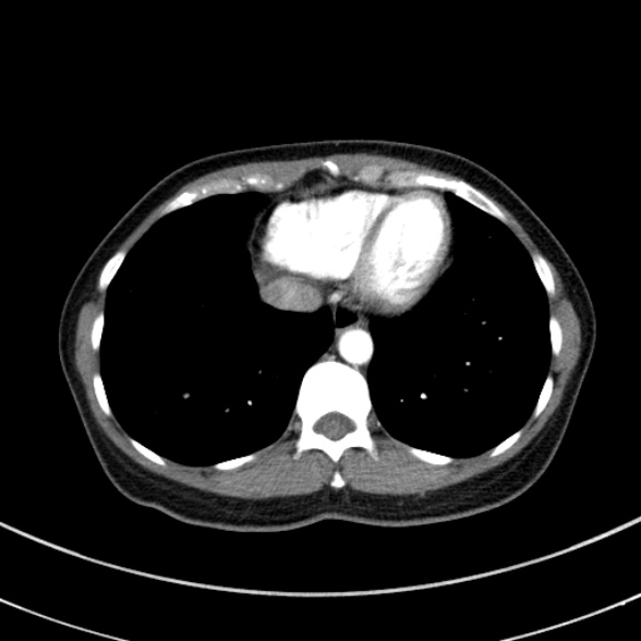 File:Adenocystic carcinoma of the trachea (Radiopaedia 47677-52525 Axial C+ arterial phase 68).jpg