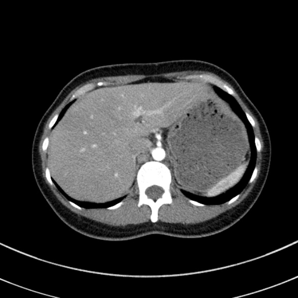 File:Adenocystic carcinoma of the trachea (Radiopaedia 47677-52525 Axial C+ arterial phase 76).jpg