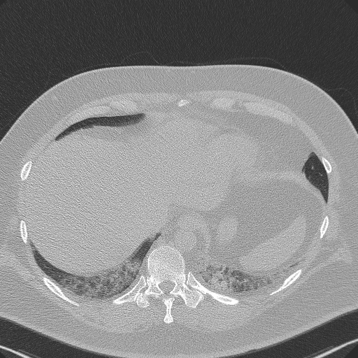 Adenoid cystic carcinoma of the trachea (Radiopaedia 49042-54137 Axial lung window 287).jpg