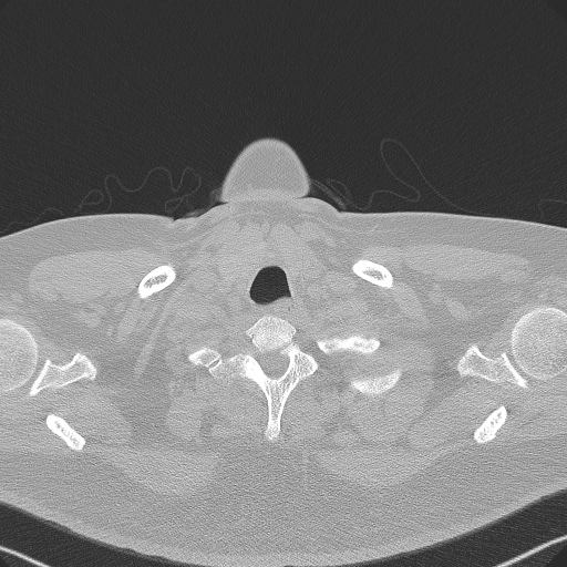 Adenoid cystic carcinoma of the trachea (Radiopaedia 49042-54137 Axial lung window 9).jpg