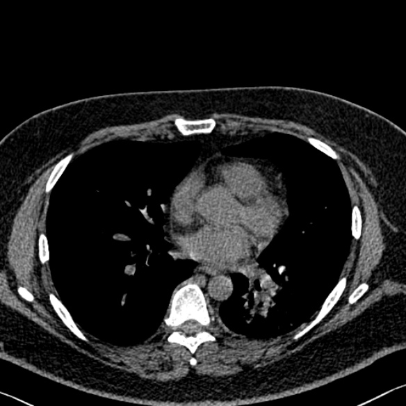 Adenoid cystic carcinoma of the trachea (Radiopaedia 49042-54137 Axial non-contrast 199).jpg