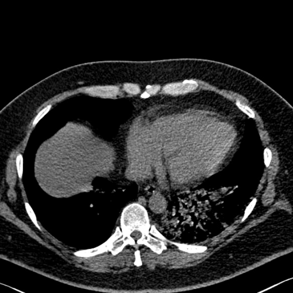 File:Adenoid cystic carcinoma of the trachea (Radiopaedia 49042-54137 Axial non-contrast 255).jpg