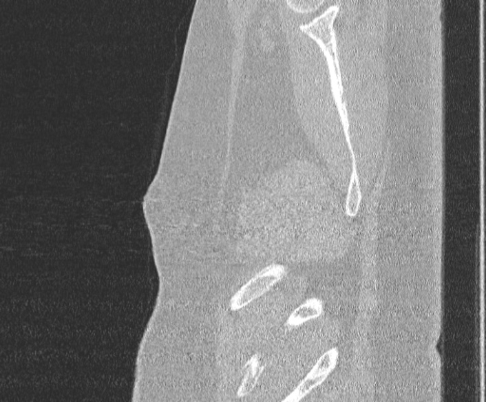 Adenoid cystic carcinoma of the trachea (Radiopaedia 49042-54137 Sagittal lung window 20).jpg