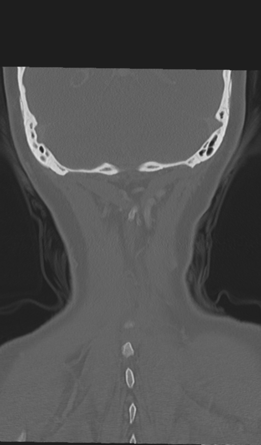 Adenoid cystic tumor of palate (Radiopaedia 46980-51518 Coronal bone window 53).png
