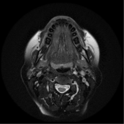 File:Adenoid cystic tumor of palate (Radiopaedia 46980-51519 Axial T2 15).png