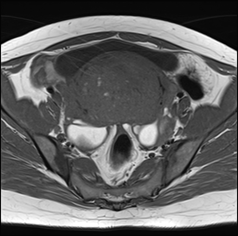 File:Adenomyosis - ovarian endometriomas (Radiopaedia 67031-76350 Axial T1 12).jpg
