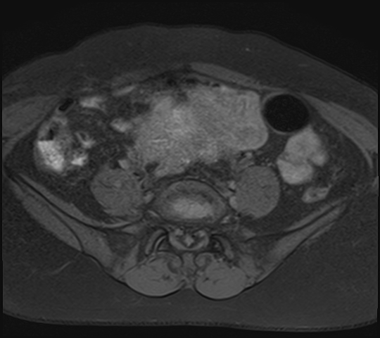 File:Adenomyosis - ovarian endometriomas (Radiopaedia 67031-76350 Axial T1 fat sat 5).jpg