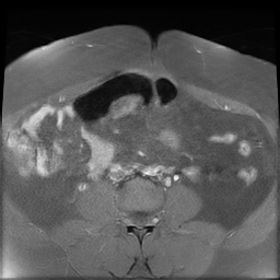 File:Adenomyosis within a didelphys uterus (Radiopaedia 70175-80215 Axial T1 C+ fat sat 7).jpg