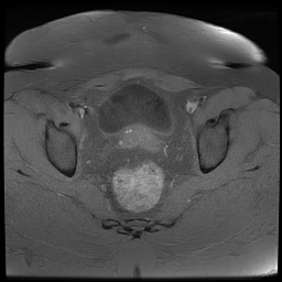 File:Adenomyosis within a didelphys uterus (Radiopaedia 70175-80215 Axial T1 fat sat 28).jpg