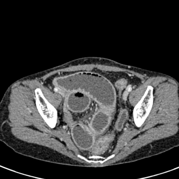 File:Adhesional small bowel obstruction (Radiopaedia 48397-53305 Axial C+ portal venous phase 79).jpg