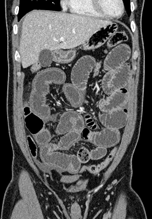 Adhesional small bowel obstruction (Radiopaedia 58900-66131 Coronal C+ portal venous phase 101).jpg