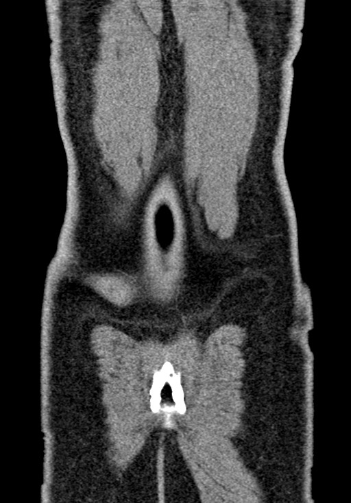 Adhesional small bowel obstruction (Radiopaedia 58900-66131 Coronal C+ portal venous phase 228).jpg