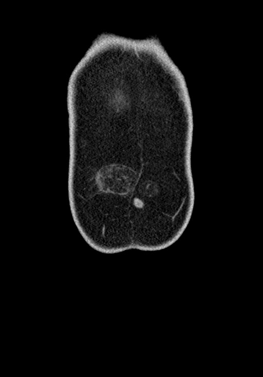 Adhesional small bowel obstruction (Radiopaedia 58900-66131 Coronal C+ portal venous phase 49).jpg