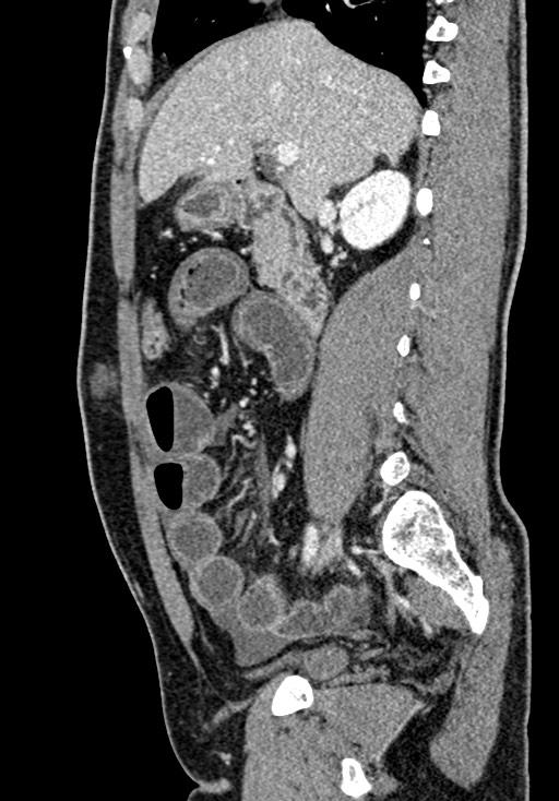 Adhesional small bowel obstruction (Radiopaedia 58900-66131 Sagittal C+ portal venous phase 96).jpg