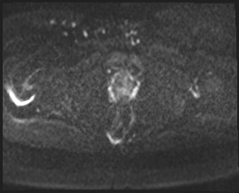 Adnexal multilocular cyst (O-RADS US 3- O-RADS MRI 3) (Radiopaedia 87426-103754 Axial DWI 52).jpg