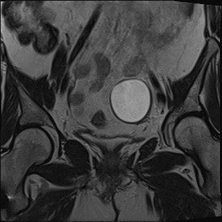 File:Adnexal multilocular cyst (O-RADS US 3- O-RADS MRI 3) (Radiopaedia 87426-103754 Coronal T2 15).jpg