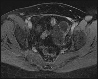 File:Adnexal multilocular cyst (O-RADS US 3. O-RADS MRI 3) (Radiopaedia 87426-103754 Axial 233).jpeg
