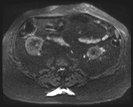 Adrenal cortical carcinoma (Radiopaedia 64017-72770 Axial DWI 78).jpg