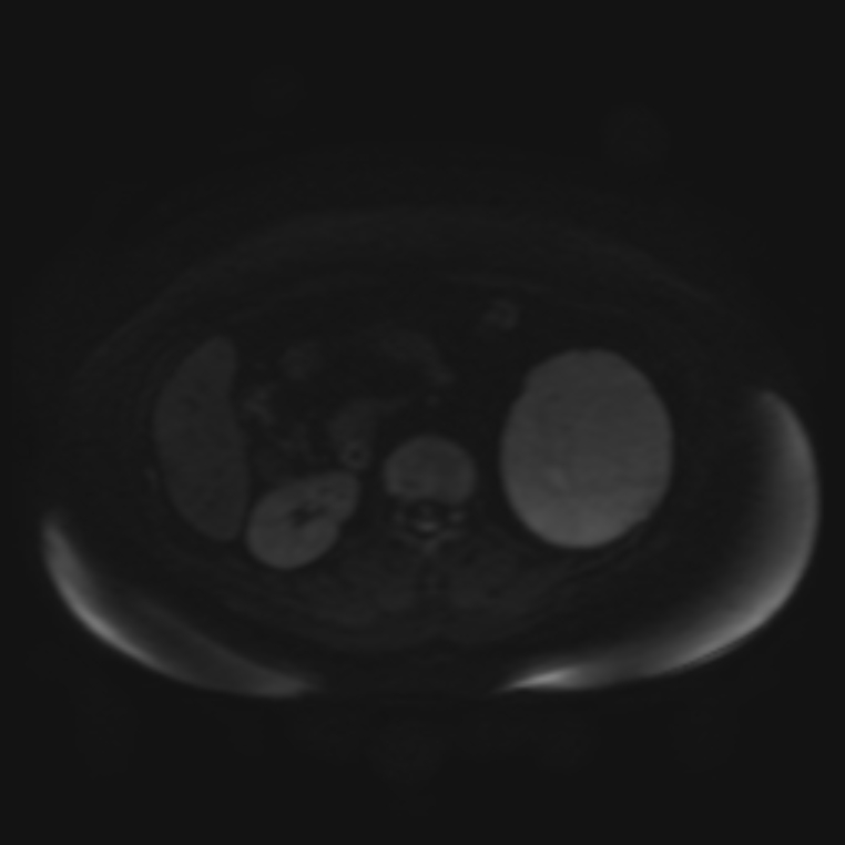 Adrenal cortical carcinoma (Radiopaedia 70906-81116 Axial DWI 45).jpg