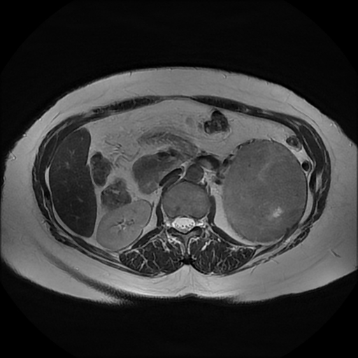 File:Adrenal cortical carcinoma (Radiopaedia 70906-81116 Axial T2 20).jpg