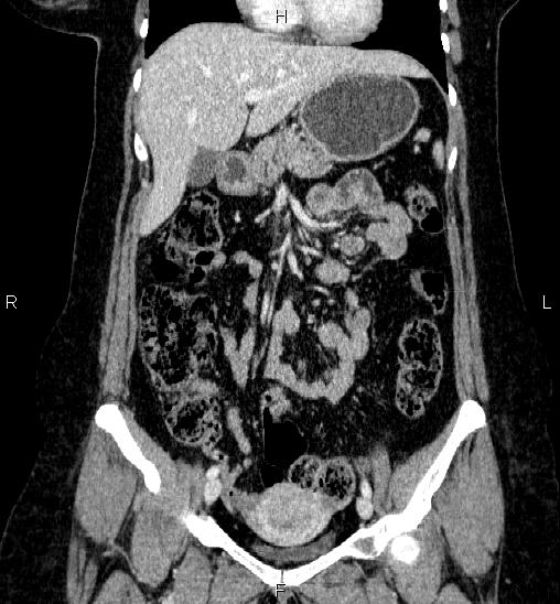 Adrenal cortical carcinoma (Radiopaedia 84882-100379 Coronal C+ portal venous phase 24).jpg