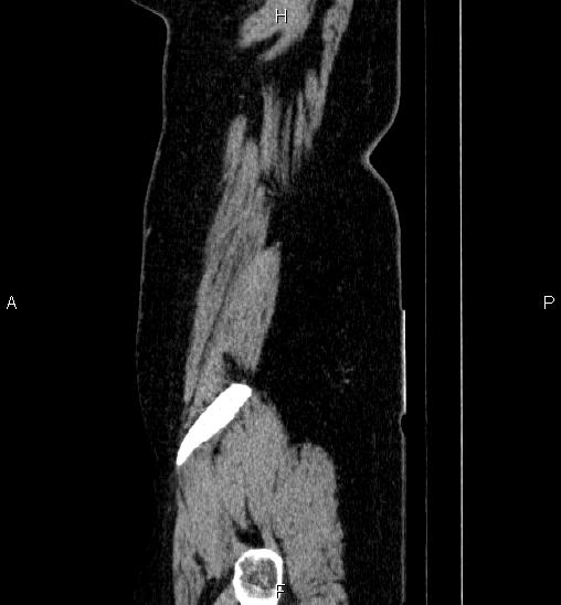 Adrenal cortical carcinoma (Radiopaedia 84882-100379 Sagittal C+ portal venous phase 85).jpg