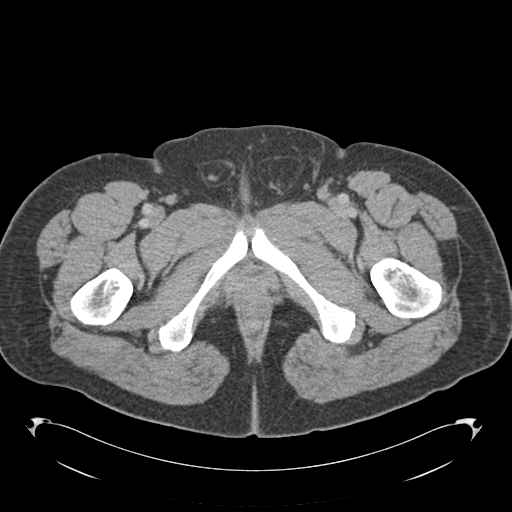 File:Adrenal cyst (Radiopaedia 45625-49776 Axial C+ portal venous phase 104).png
