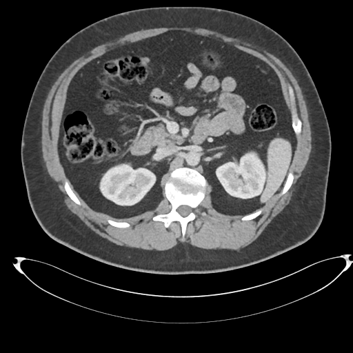File:Adrenal cyst (Radiopaedia 45625-49778 AXIAL THICK 60 sec 31).png
