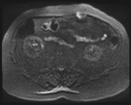 Adrenal cystic lymphangioma (Radiopaedia 83161-97534 Axial C+ portal venous phase 38).jpg