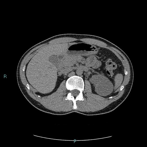 Adrenal cystic lymphangioma (Radiopaedia 83161-97534 Axial non-contrast 34).jpg