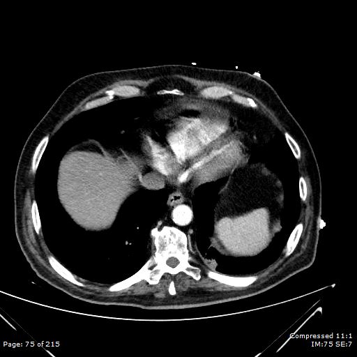 Adrenal metastasis (Radiopaedia 78425-91079 Axial C+ arterial phase 5).jpg