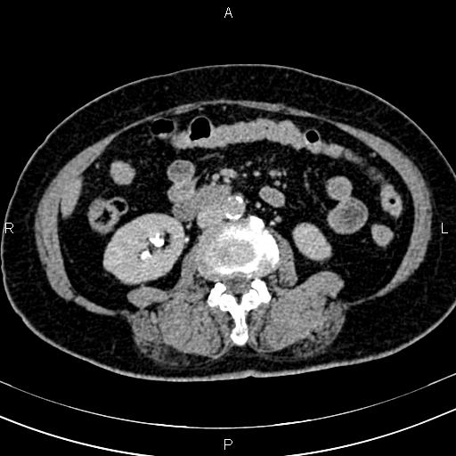 Adrenal myelolipoma (Radiopaedia 82742-96986 Axial renal excretory phase 78).jpg