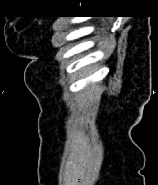 Adrenal myelolipoma (Radiopaedia 82742-96986 Sagittal renal cortical phase 14).jpg