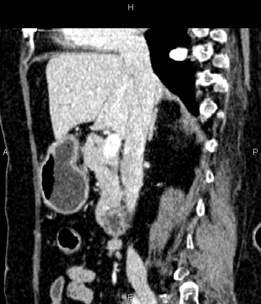 Adrenal myelolipoma (Radiopaedia 82742-96986 Sagittal renal cortical phase 49).jpg