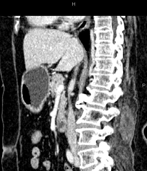 Adrenal myelolipoma (Radiopaedia 82742-96986 Sagittal renal cortical phase 54).jpg