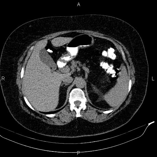 Adrenal myelolipoma (Radiopaedia 84319-99617 Axial With oral contrast 65).jpg