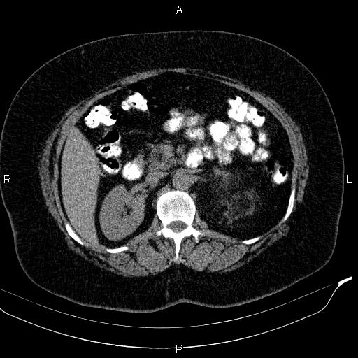 Adrenal myelolipoma (Radiopaedia 84319-99617 Axial With oral contrast 86).jpg