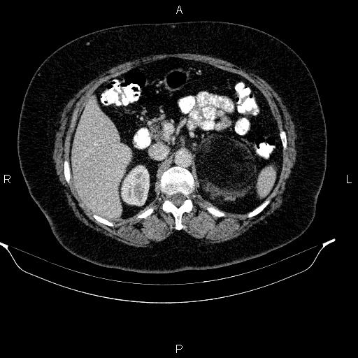 Adrenal myelolipoma (Radiopaedia 84319-99617 Axial renal cortical phase 42).jpg