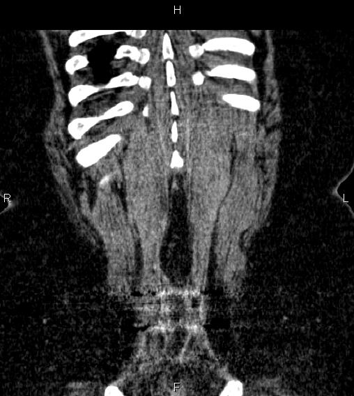 Adrenal myelolipoma (Radiopaedia 84319-99617 Coronal renal cortical phase 74).jpg