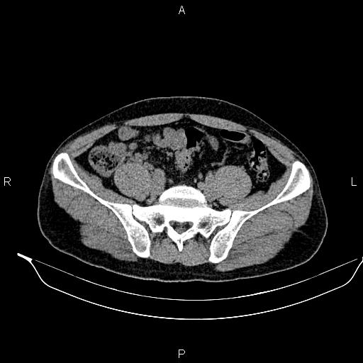 Adrenal myelolipoma (Radiopaedia 87794-104246 Axial non-contrast 78).jpg